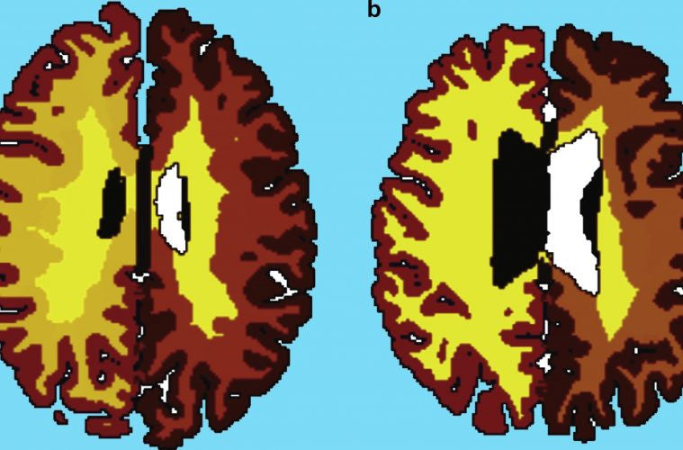 Study Reveals How Being Overweight Effects Your Brain